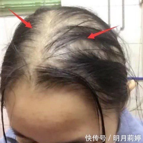 16岁女孩长期“不剪头发”，身体出现这变化，女生请务必了解！