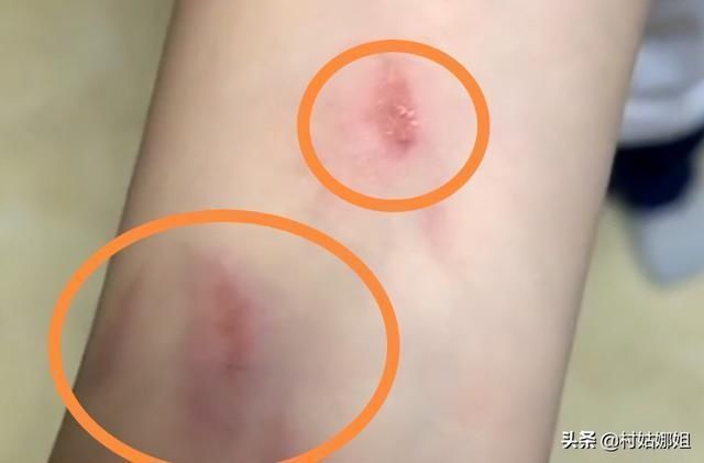 衣服|幼儿园女儿放学后胳膊有淤青,老师:她穿了件裙子,所以才出事的