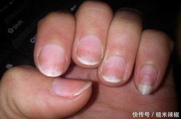 指甲上出现竖纹，主要和3个问题有关，别再忽视
