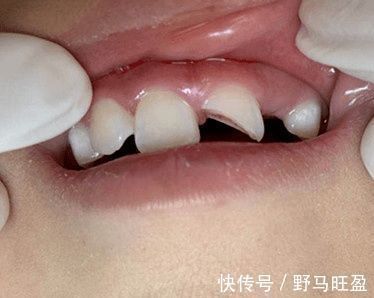 牙根|牙医姐姐讲故事︱断牙如何修补？别让意外“折”了童年的欢乐