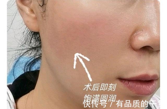 面部 玻尿酸填充的时候疼吗术后效果咋样!
