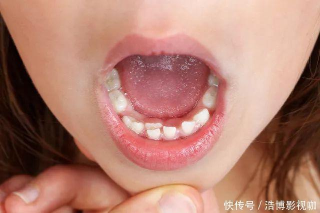 孩子|为何现在“双排牙”的孩子越来越多医生跟家长脱不了干系!