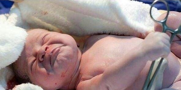 脐带|刚剖腹出来的宝宝伸手抓住医生的剪刀,不让剪断脐带!