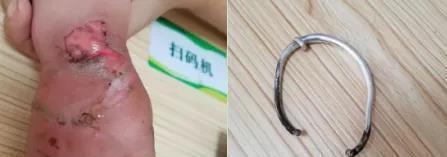 反目|过生日毁了孩子一只手!家人反目:谁让你给娃送这个?