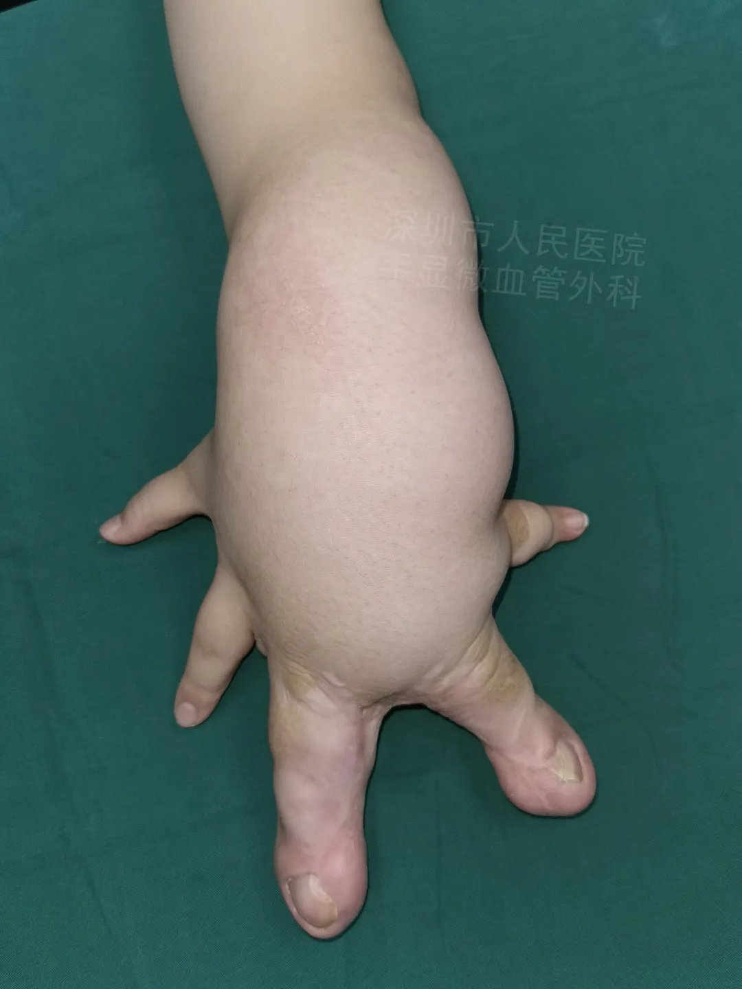 发育不良|得了这病,12岁男孩手指比香蕉还粗!7种常见的手部畸形,家长们要注意