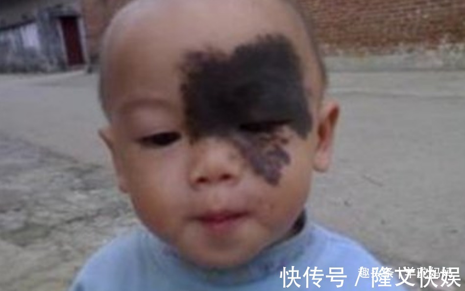 血管瘤|越来越多胎儿被“胎记”缠身,若不想孩子自卑,孕妈要管住自己