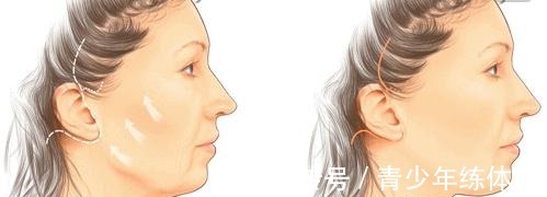 拉皮 小拉皮术后6个月,让她从老阿姨逆袭小姐姐!