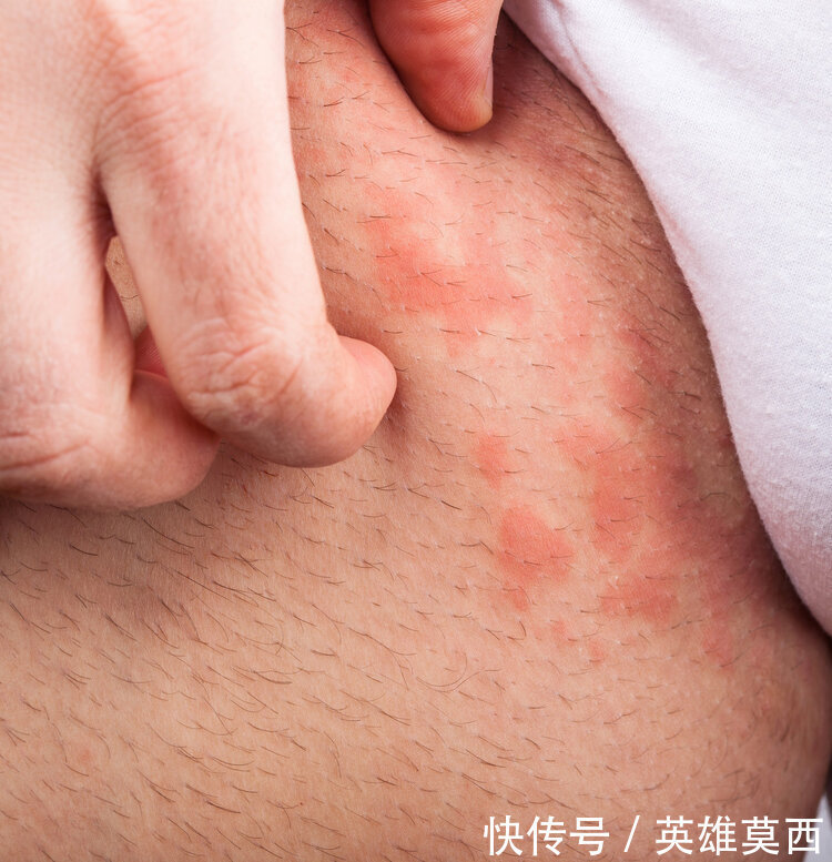 发作|湿疹反复发作奇痒难耐中医给出两种治疗方法,可有效止痒治湿疹