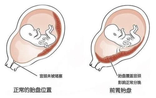 孕妈|孕妇几个月开始“显怀”呢？过早显怀一般有这3种原因，你中了吗