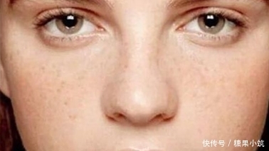 脸上长斑是怎么回事?可能和以下这几大因素有关?