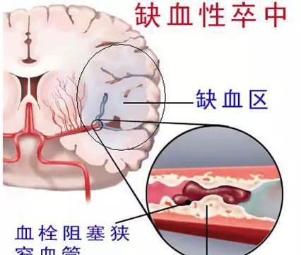  脖子|为什么这么多中国人有脑梗因为脖子上长了这个东西