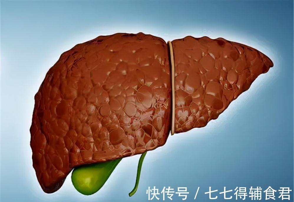 肝功能|肝硬化进入晚期的6大征兆,肝病患者一定要记住,关键时刻能救命