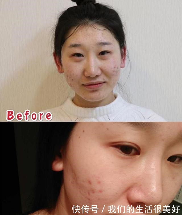 后感 M22光子嫩肤后感!