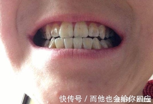 黄牙|牙齿发黄，教你一招，这样做，就能让你一周拥有一口大白牙