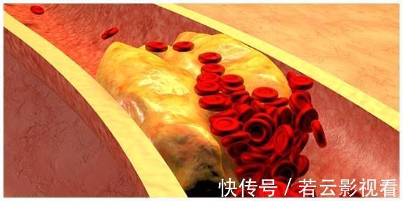 血脂异常|血脂高不高,看脸就知道,若没有这3个症状,恭喜血脂控制得不错