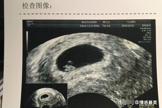 胎停育怎么办？害怕胎停的孕妈别慌，教你如何正确理解HCG值