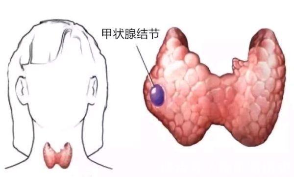 苦瓜|冬天,甲状腺结节患者能吃羊肉吗?提醒:2种肉尽量少吃一些
