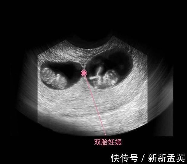 胚胎|胎儿从卵泡到性别形成,17张图片清晰诠释,男宝女宝看得很清楚