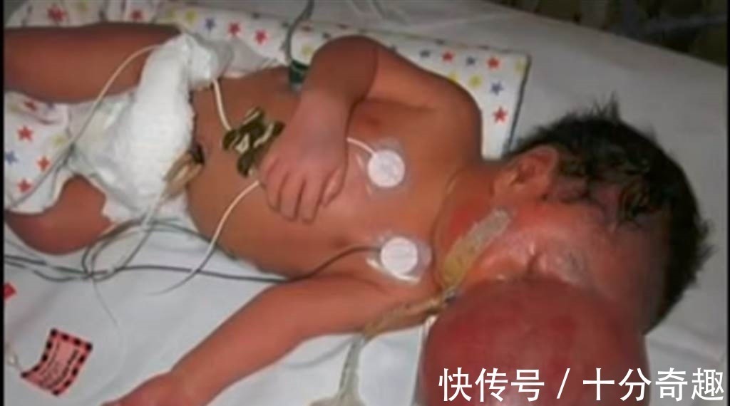 帅哥|婴儿大脑长头颅外 手术后变小帅哥萌歪所有人