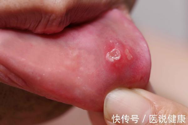 槟榔素|女子连续口腔溃疡一个月,为何最终查出舌癌?这6类人可得当心