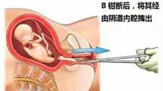 流产|朋友意外怀孕要人工流产，看到这组流产过程图，她哭了