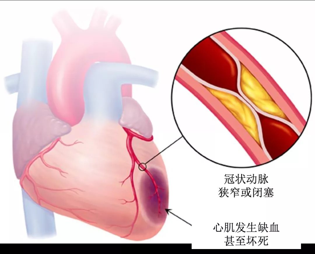 起搏器|“心门”坏了、冠脉堵塞、心脏乱跳,一根导管解决诸多心脏顽疾