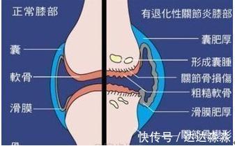 老中医|膝盖肿走不了路?老中医:白醋加它这样用!滑膜炎不用怕!