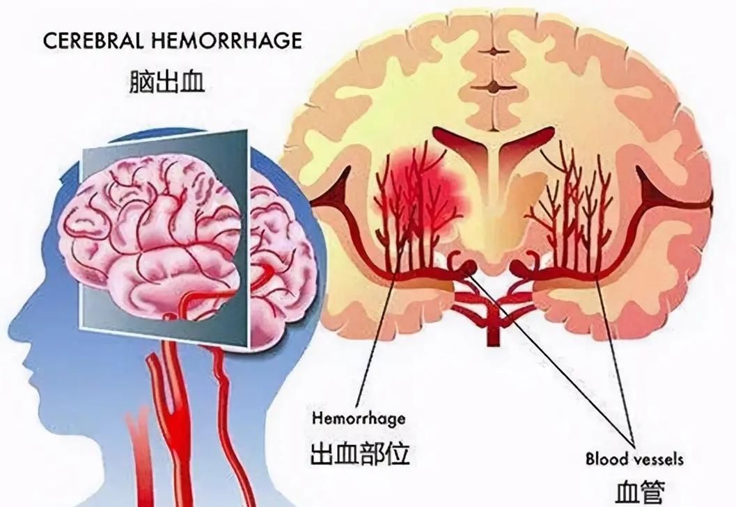 老人|家里老人突发脑溢血咋办？本文教您急救方法，4个步骤记清楚了