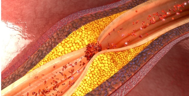 胆固醇|高血脂是吃出来的坚持“两低一高”饮食，2个月轻松吃掉高血脂