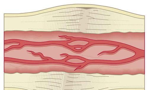 逆转|动脉粥样硬化可以逆转,一招可将血管壁清理干净,软化血管溶血栓