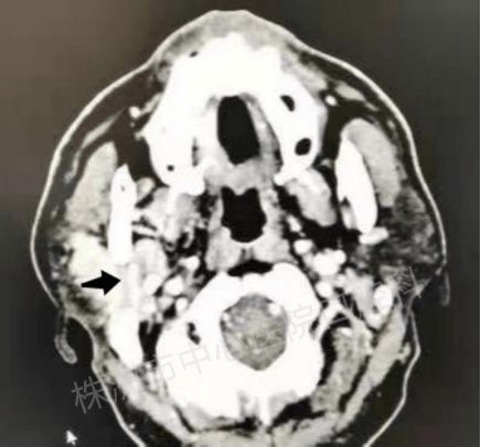 肿瘤|注意！耳朵下这块不痛不痒的鼓包，可能是腮腺肿瘤