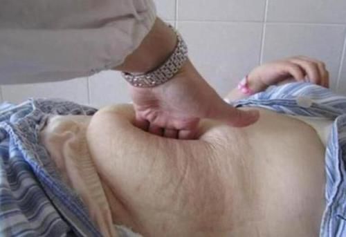 同样是剖腹产为什么有的产妇压肚子有的不用过来人才懂的痛