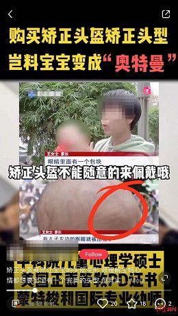 头型|婴儿戴“头盔”矫正头型，是父母审美偏执症在作怪