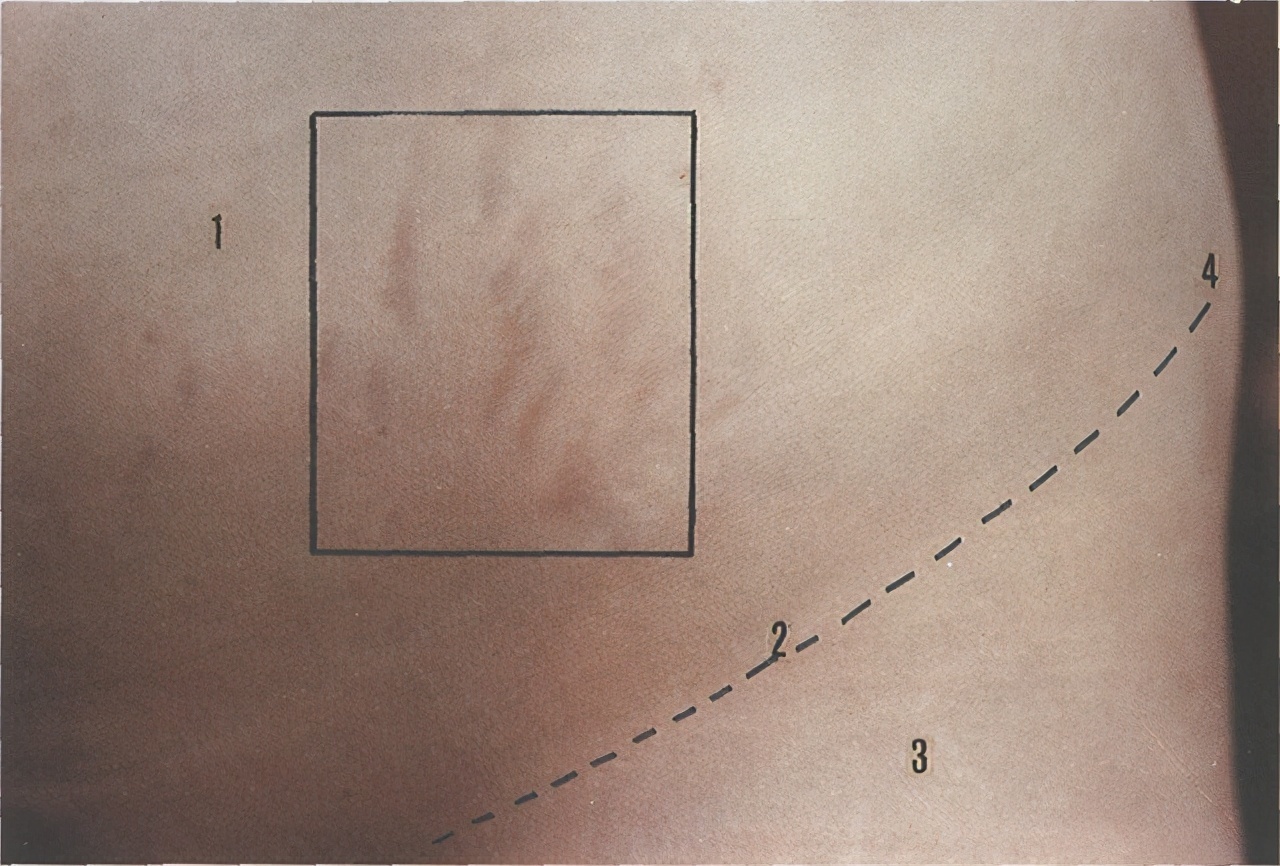 小丽|怀孕后,为啥有人会长妊娠纹,有人却不会长和这四个因素有关