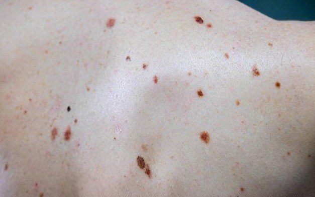 黄曲霉毒素|身体出现“小红点”,八成是肝喊疼了,忠告要忌口