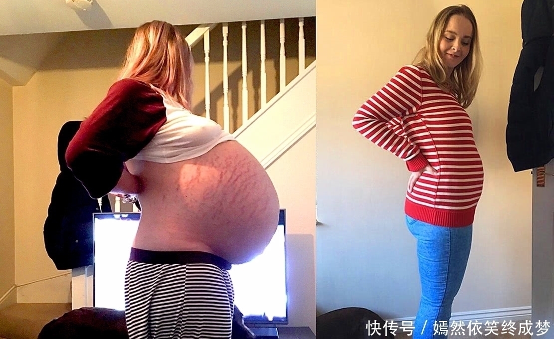 法维尔|英国女子肚子涨大以为怀有身孕,医生发现她腹中并非胎儿