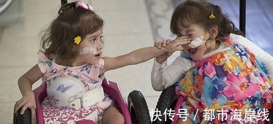 一条腿|3岁连体姐妹,成功做了人体分离手术,可惜术后每人只有一条腿