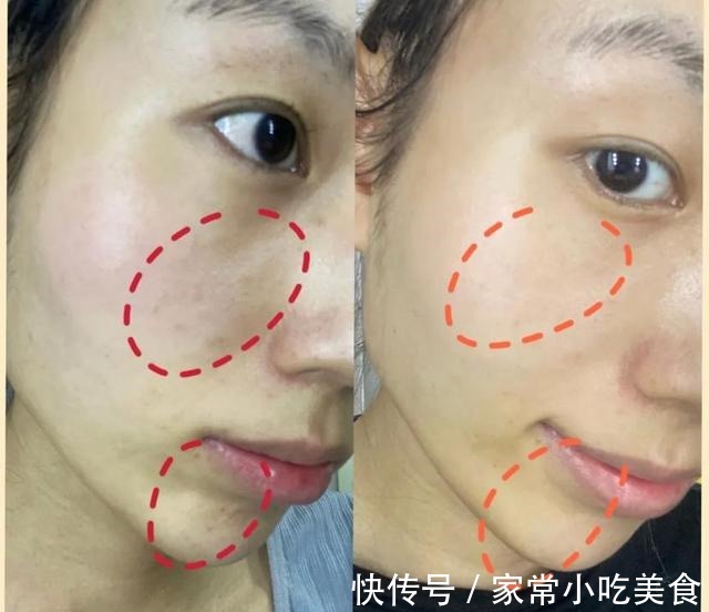 光子嫩肤 Dpl光子嫩肤效果怎么样!