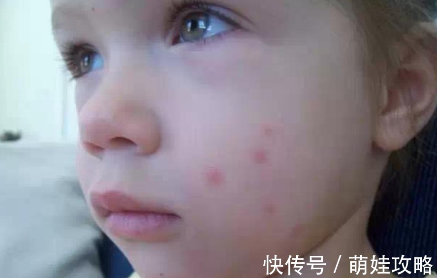 宝宝|宝宝被蚊子叮咬后,第一步不是帮娃止痒,很多家长都做错了