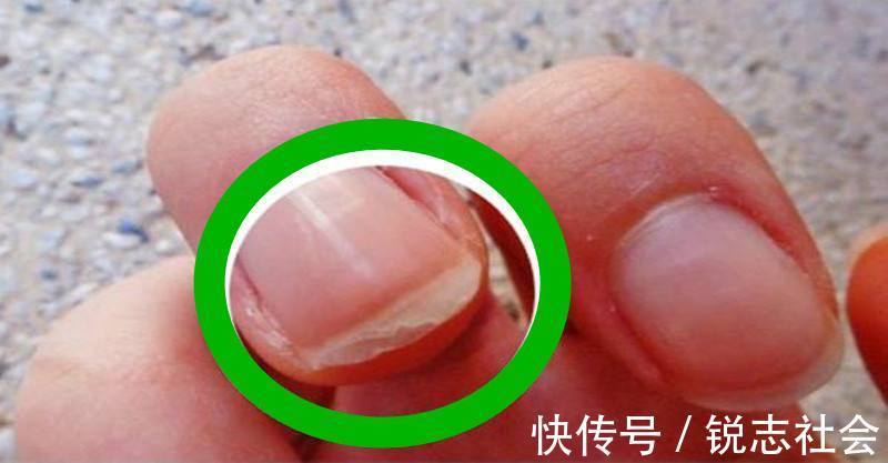 指甲|肝炎加重了伸开双手就知道,3变化及时检查,取冰箱2物养好肝