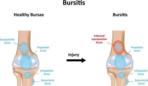 膝关节|上下楼弯腿时膝盖痛是什么原因，如何摆脱疼痛？请看此文