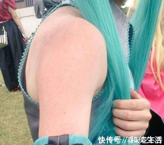 晒伤|日本宅男COS初音被严重晒伤,去年的教训只记得一半的下场