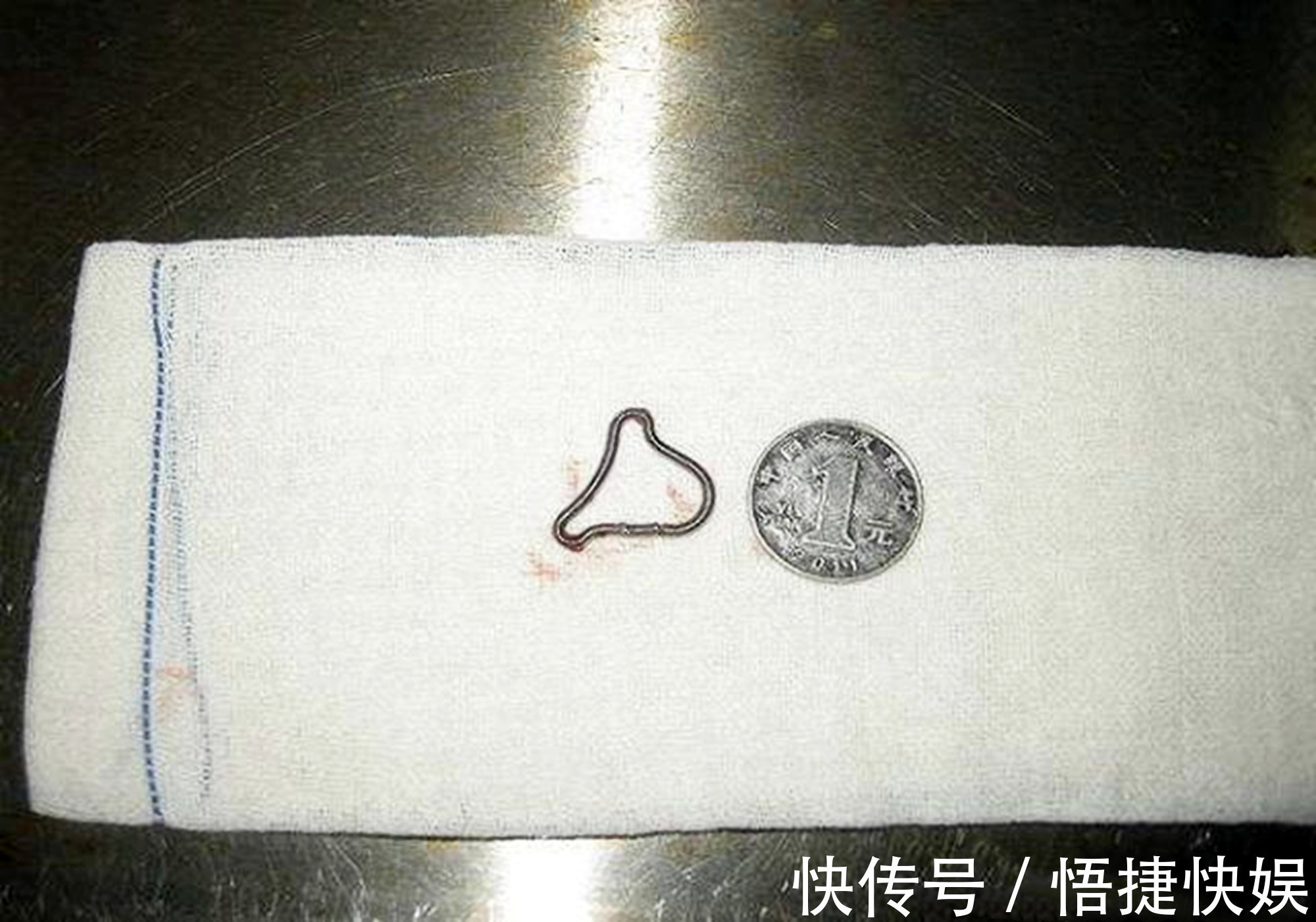 避孕|生一胎后上环,为生二胎取环,医生多亏生二胎的想法救了你