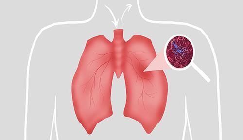 查出的肺结节，都是好的发展成为肺癌的路上，有哪些征兆