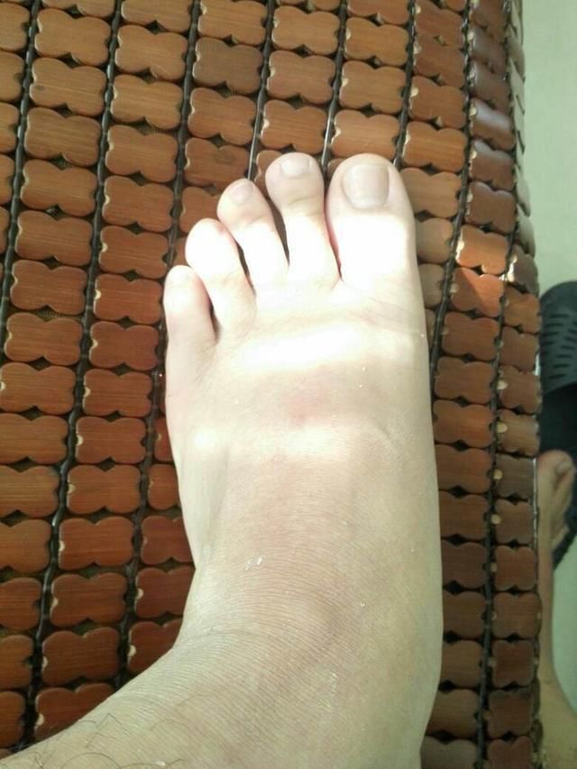 不小心烫伤了怎么办?千万不要自行乱涂牙膏等东西