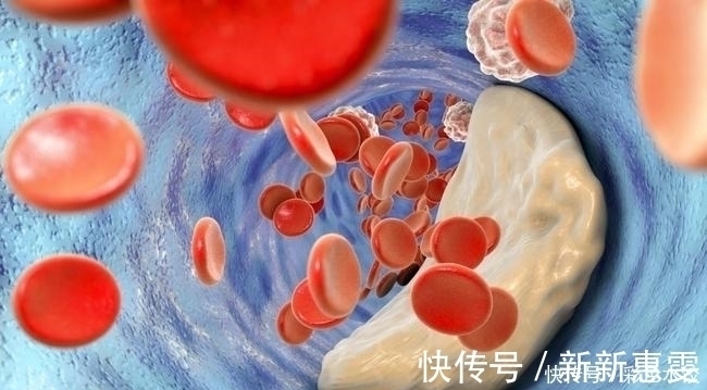 高血脂|高血脂的“源头”已发现,肥肉没上榜,第1名大家几乎每天都吃