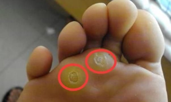妙招|原来鸡眼是这么来的，四个小妙招，教你轻松解除多时的困惑！