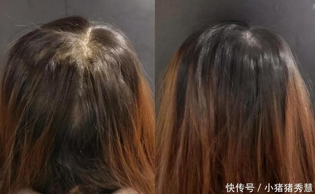 头发|头发油腻,经常抠出“白泥”?别不以为意,其实跟螨虫有大关系