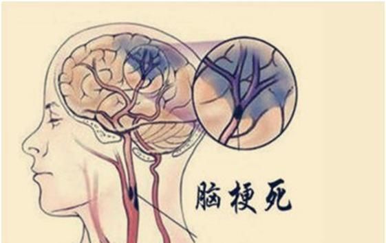 芦笋液|身上这3处发麻,多是脑梗塞的前兆,麻痹大意者,当心脑梗来袭