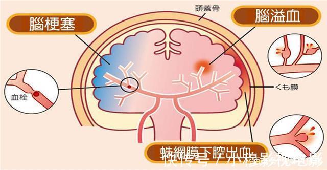 脑梗的“源头”或被发现,肥肉未上榜,第一名很多老人经常吃
